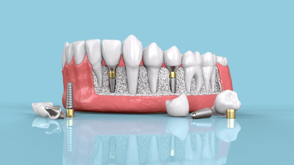 Comment savoir si l’implant dentaire est bien mis ?